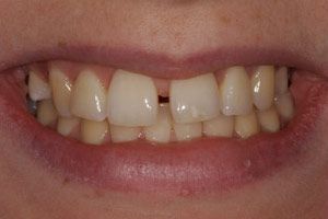 Teeth Before Inman Aligner